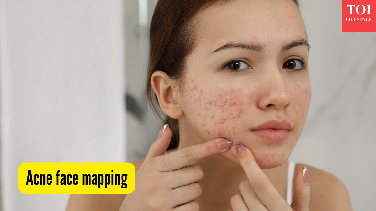 Acne mapping: What your breakout patterns reveal about skin, health, and habits