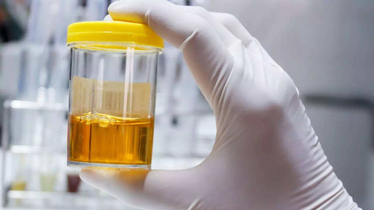 Foods and drinks that can make urine cloudy: Diseases and health conditions linked to it