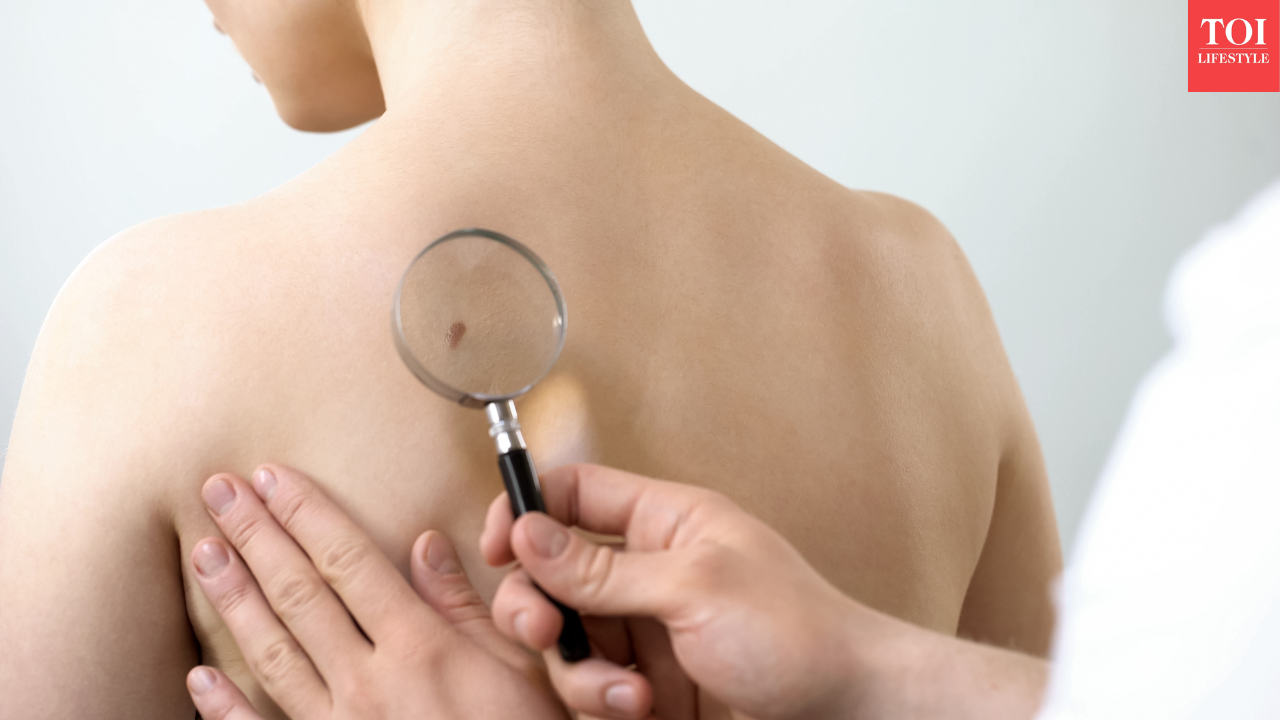 Judge Frank Caprio's son David Caprio warns about skin cancer after an alarming dermatologist visit