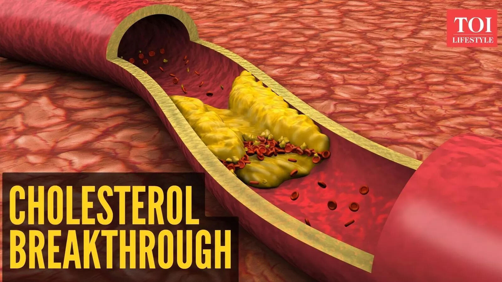 New Research Exposes a Silent Cholesterol Trap Linked to Brain Disease​