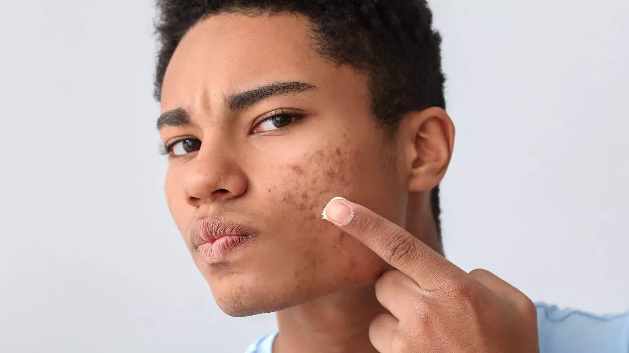 Acne trigger 7: Scented laundry detergents irritate the skin