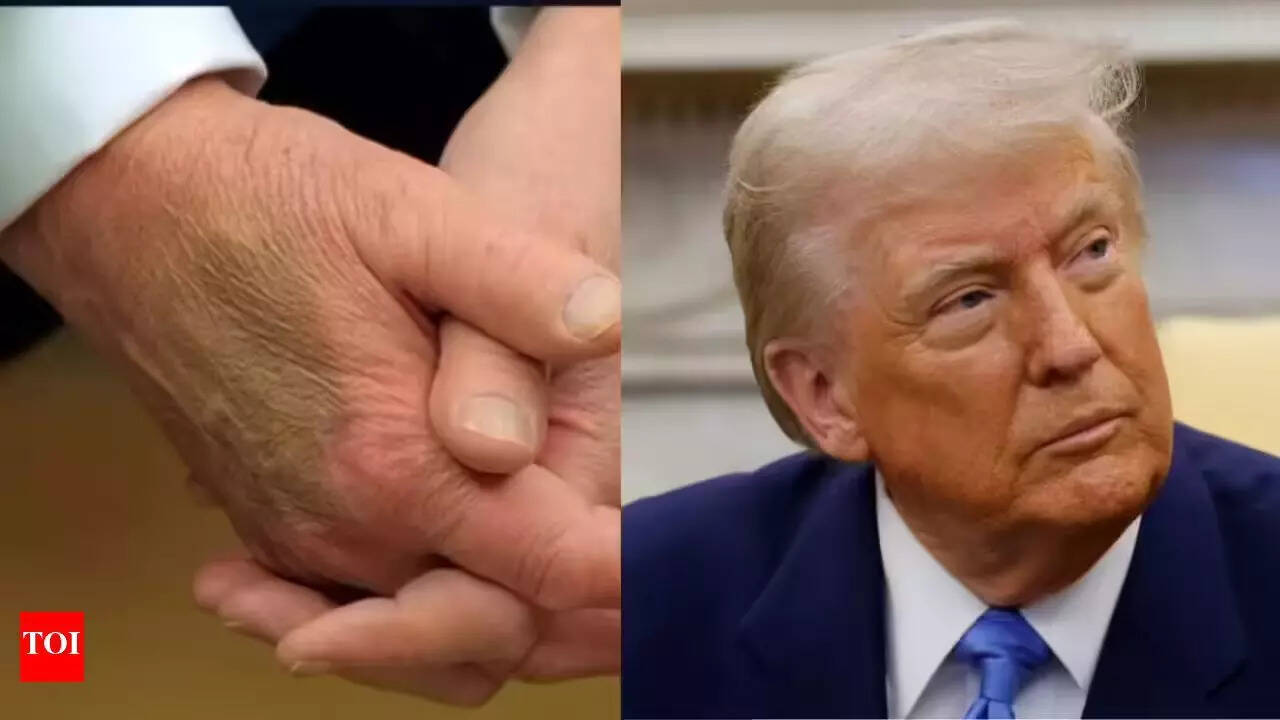 Compression socks, aspirin and makeup: Trump admits concealing visible signs of health problems