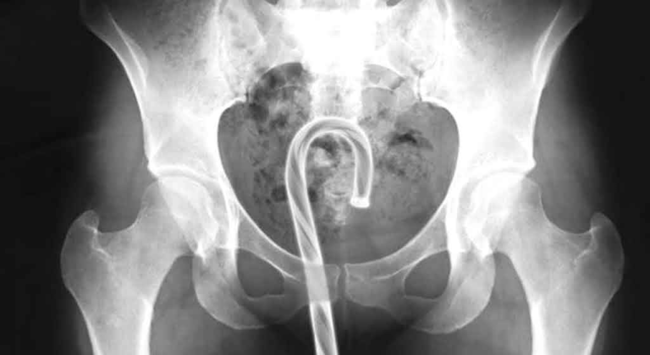 US government releases list of unusual objects surgically removed from people's rectums in 2025