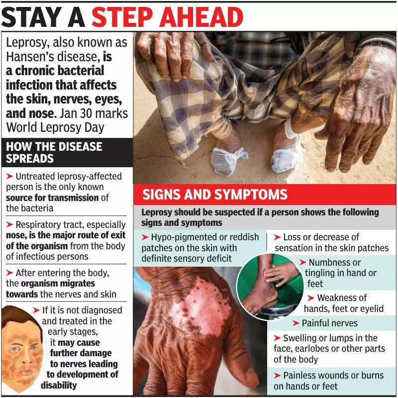 Goa continues to detect average of 70 new leprosy cases per year
