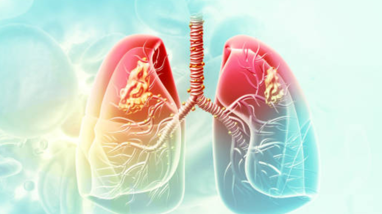 AIIMS-Delhi to study link between lung cancer and air pollution