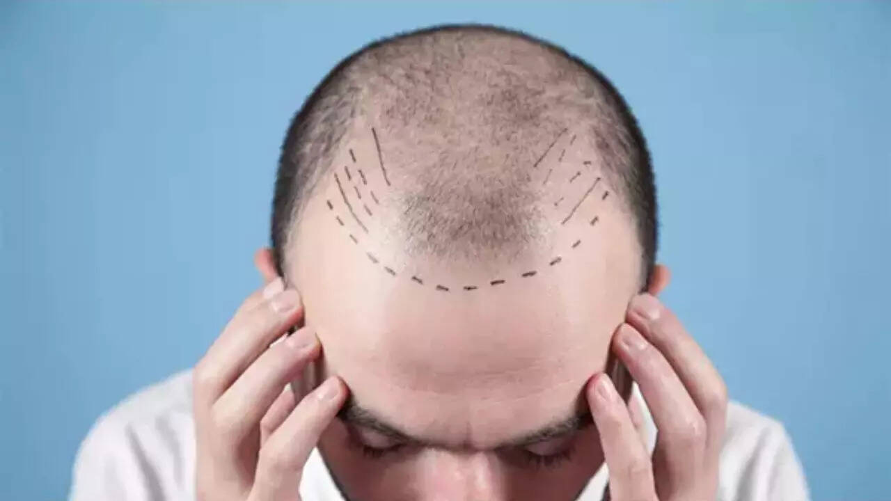 Days after TN order, doctors seek similar rules nationwide as hair transplant boom raises safety alarm