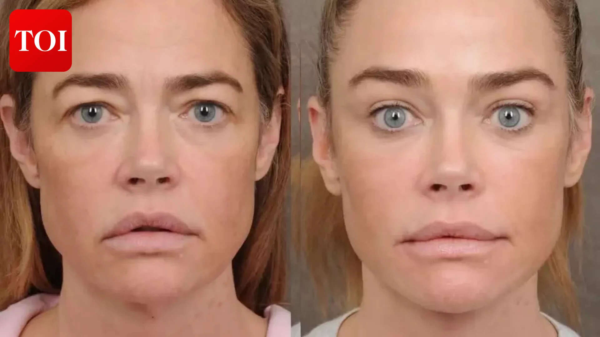 Denise Richards' before and after pics post facelift go VIRAL