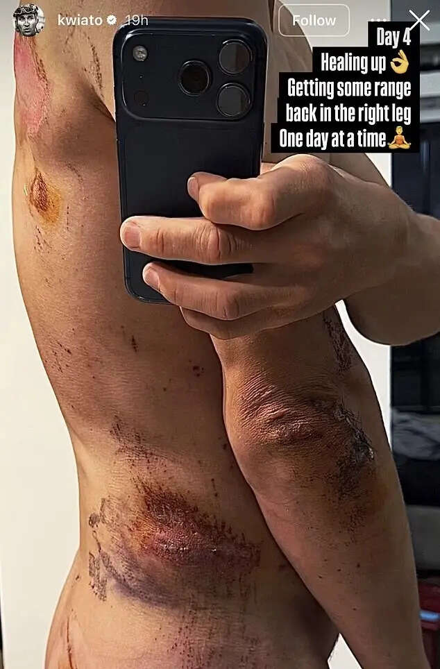Champion cyclist Michal Kwiatkowski reveals crash scars in naked photo after hitting sign post during brutal collision with rival rider