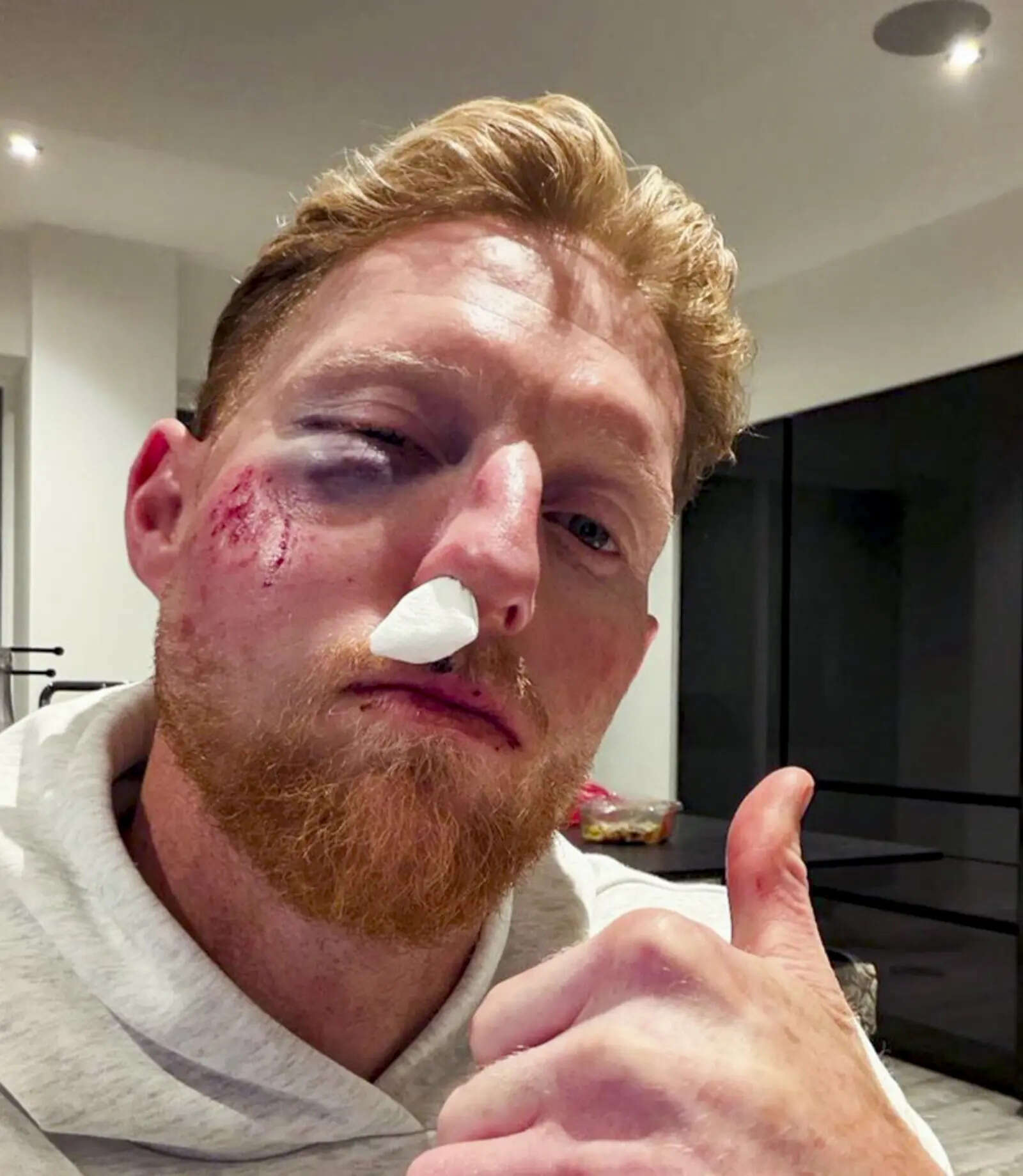 ben-stokes-suffers-facial-injury.jpg