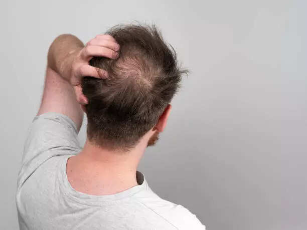 Most common culprits behind bald spots