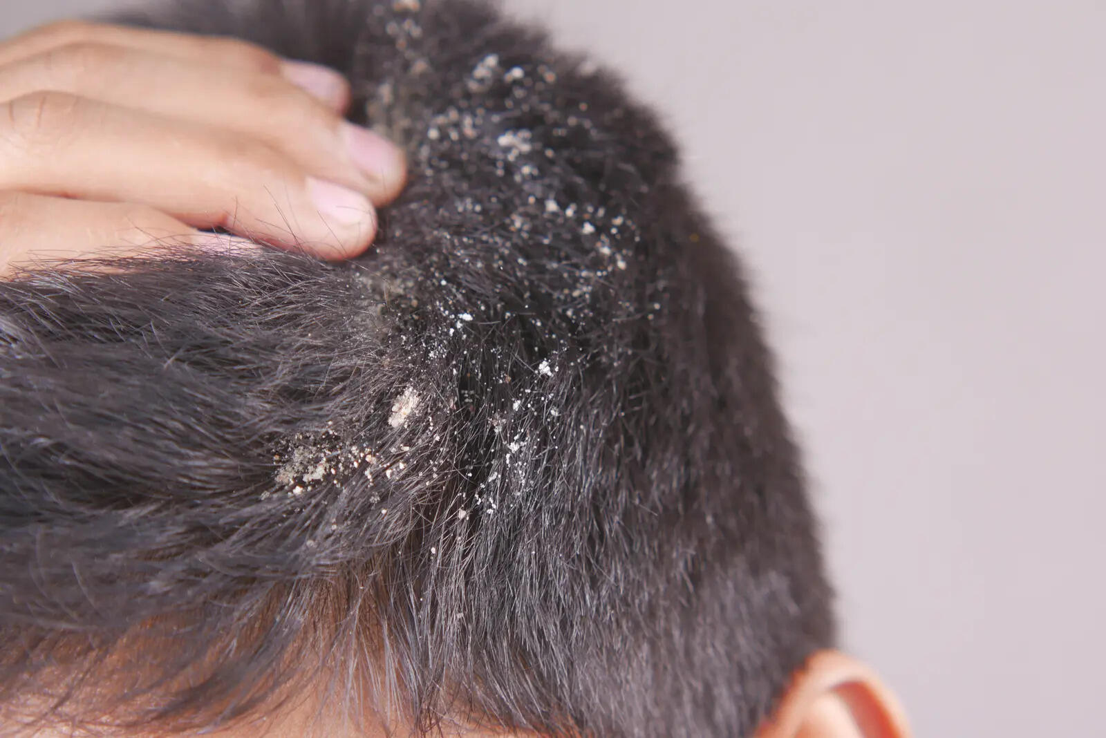 Dandruff Causes: Beyond Hygiene, Understanding Malassezia and Scalp Health