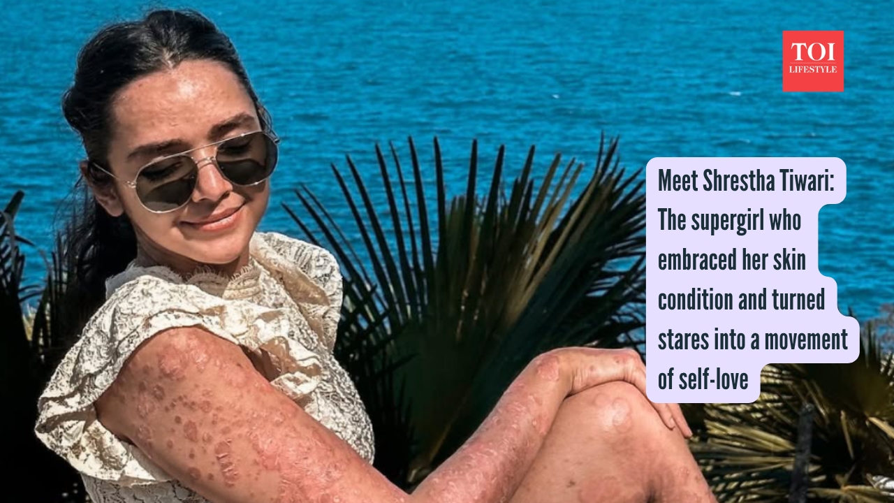 Meet Shrestha Tiwari The supergirl who embraced her skin condition and turned stares into a movement of self-love