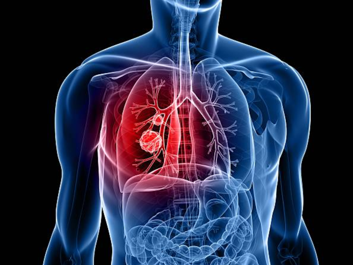 ​Indian govt aims to reduce TB incidence by 80% by 2025​