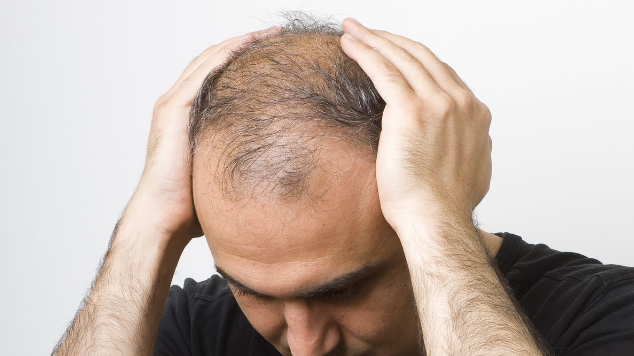 Hidden Risks of Hair Transplants