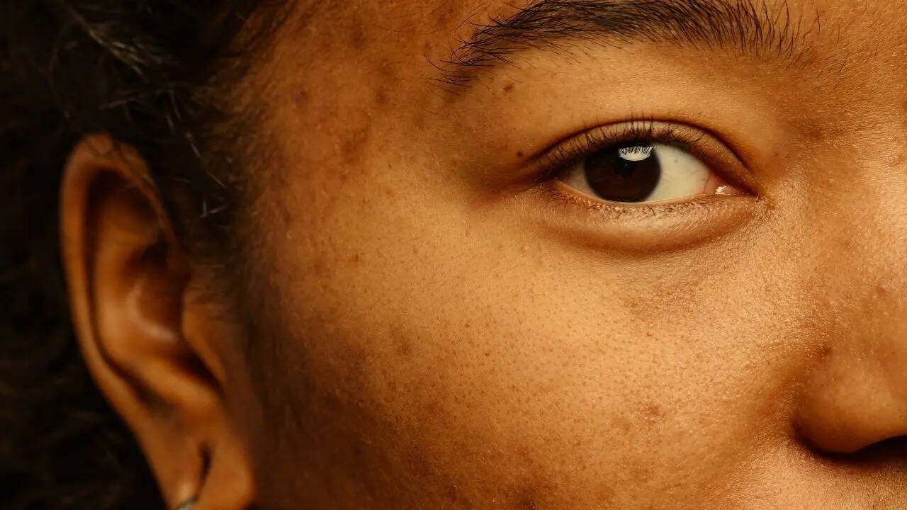 Skin pigmentation can have various treatments