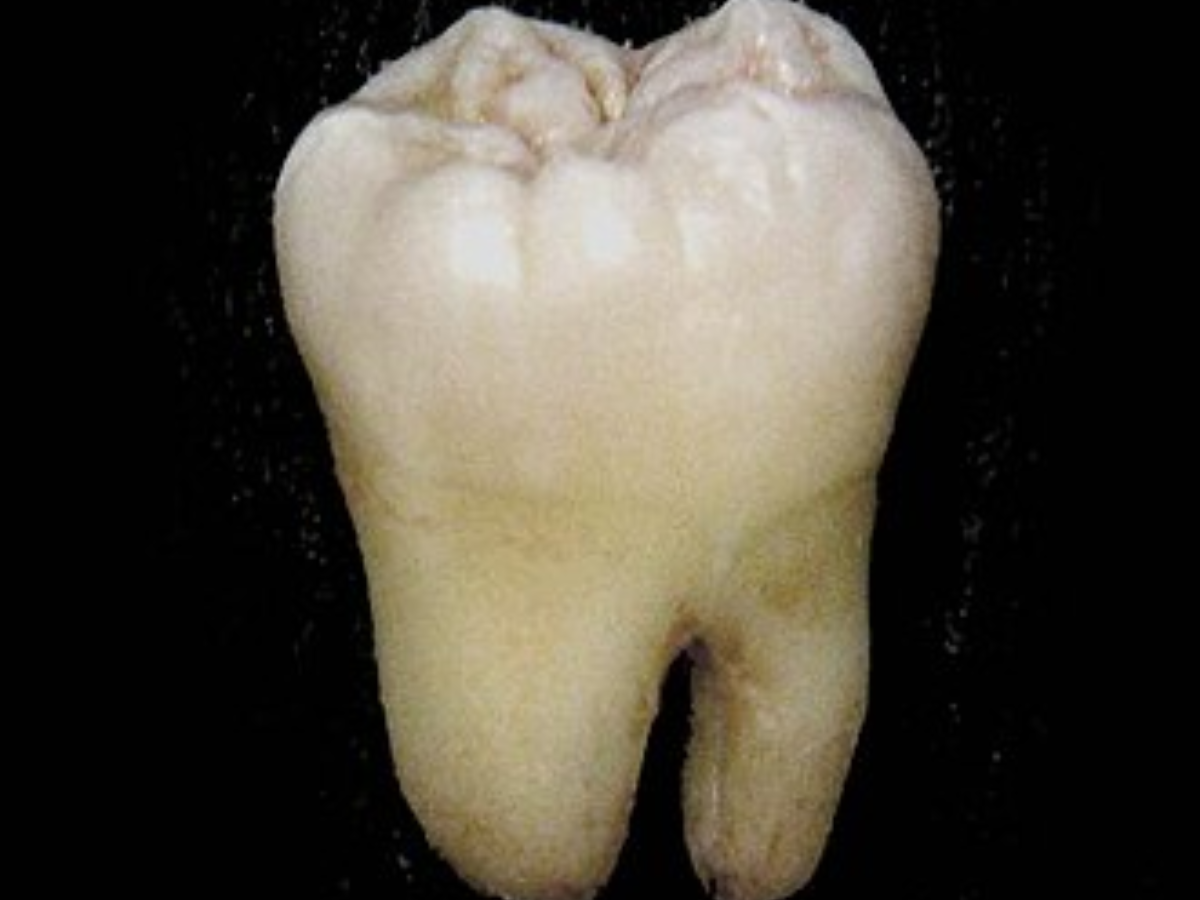Molar tooth