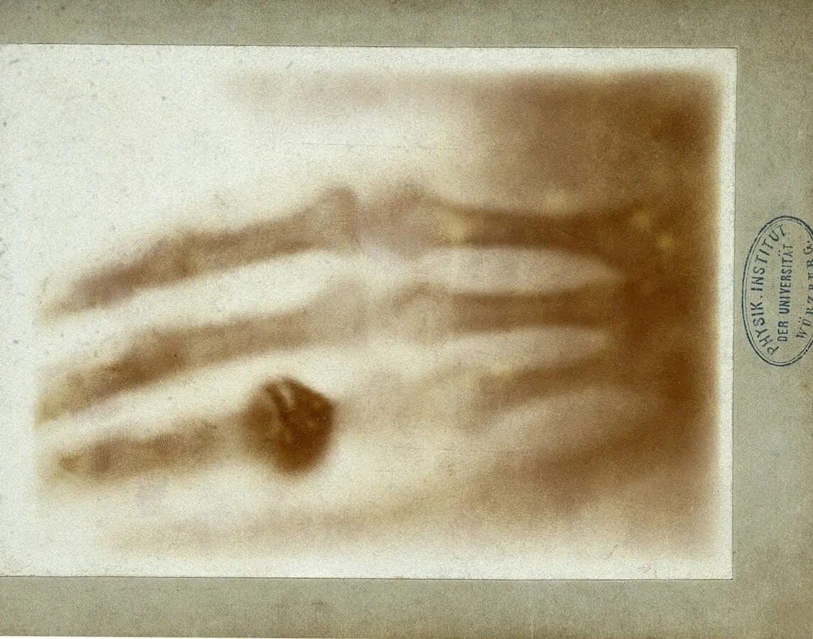 Spotting bones inside a hand for the first time, opened the door to modern radiology