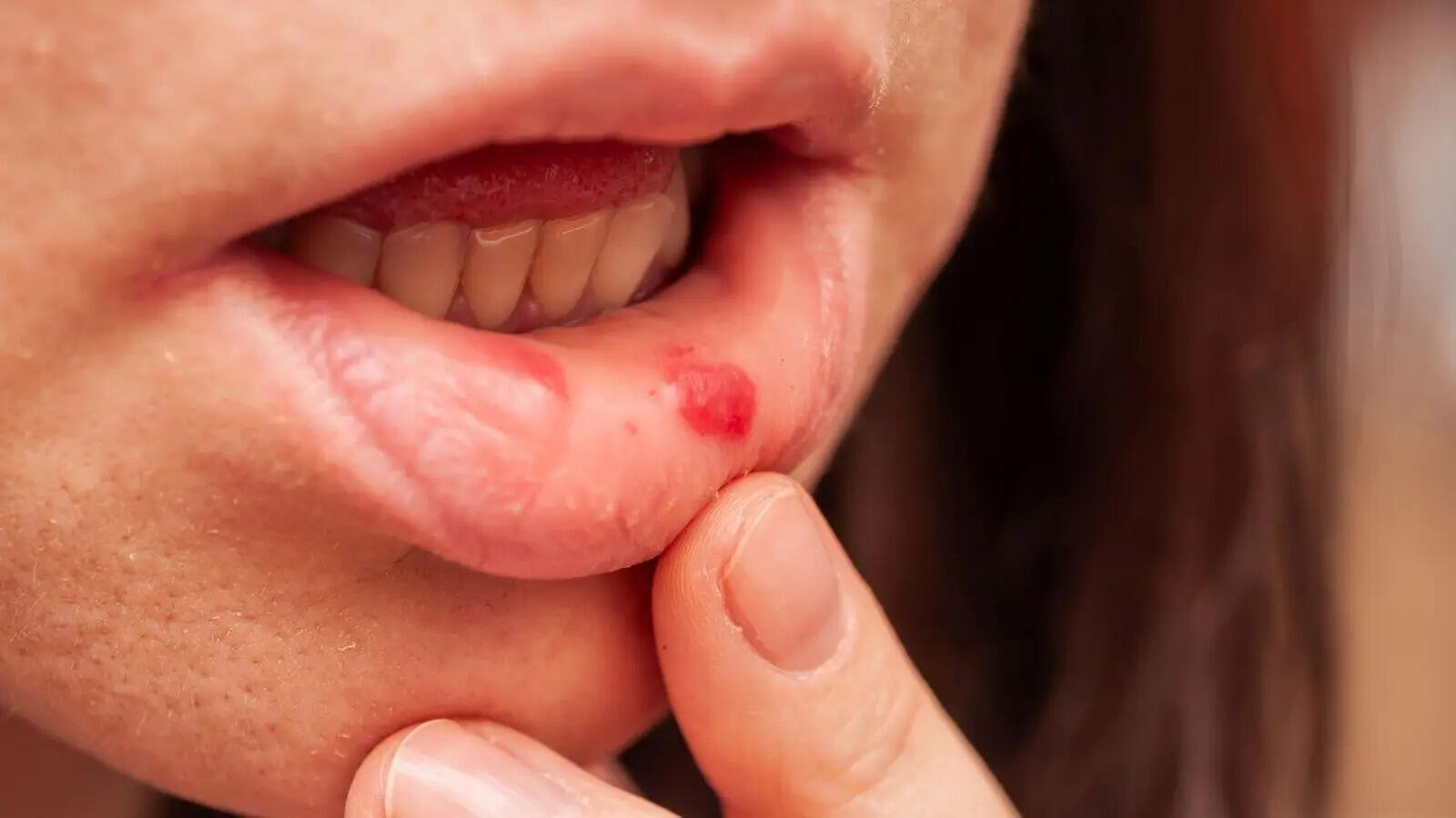 Mouth ulcer
