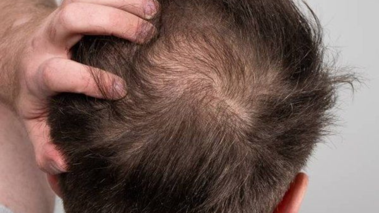 ‘Hair loss impacted my self-esteem’:  LeT terrorist says he went for transplant in India