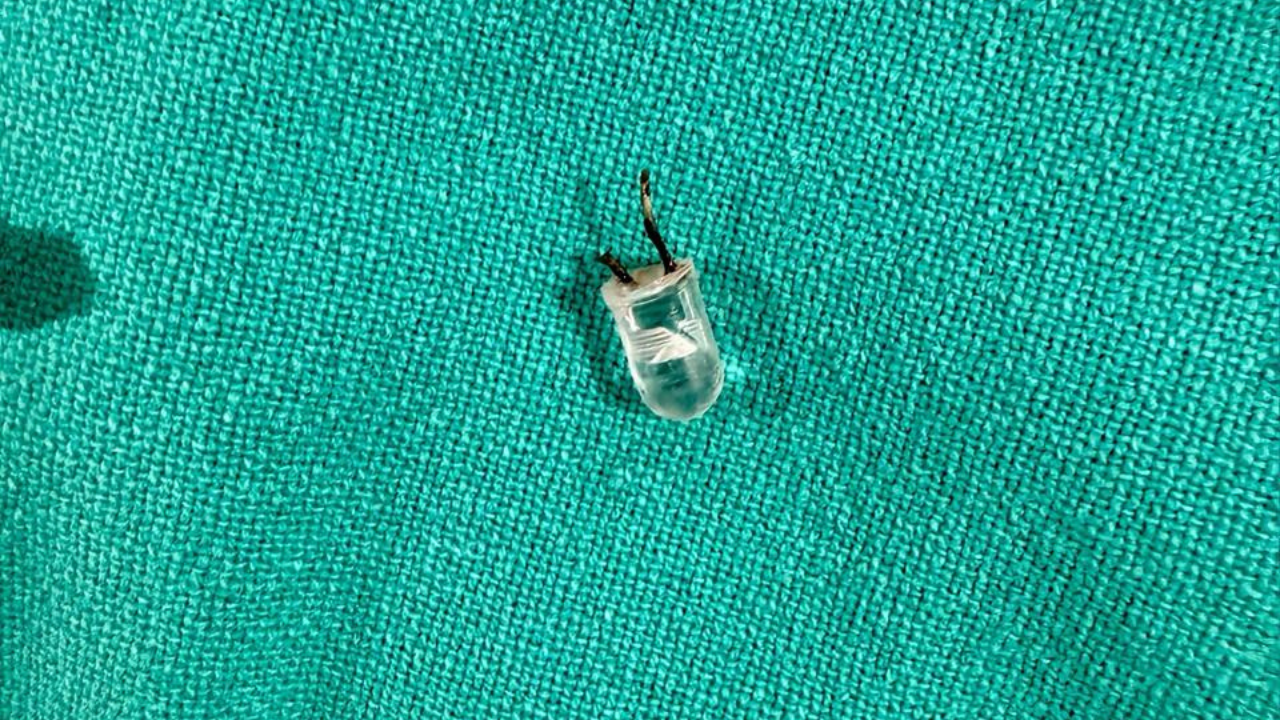 Toddler had tiny bulb stuck in his lung for a week, doctors perform delicate rescue in Faridabad hospital