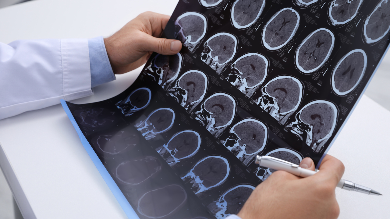 Multiple Sclerosis
