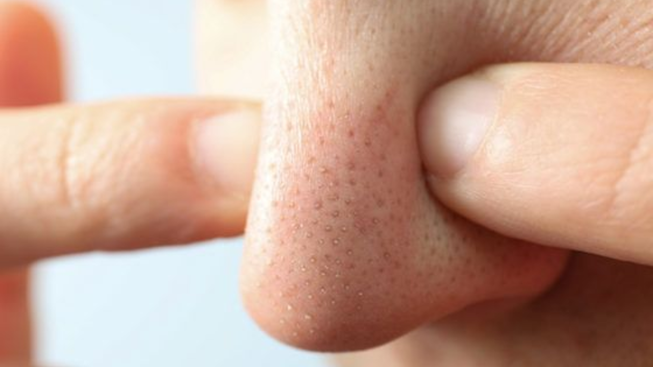 What's the Difference Between White and Blackheads?