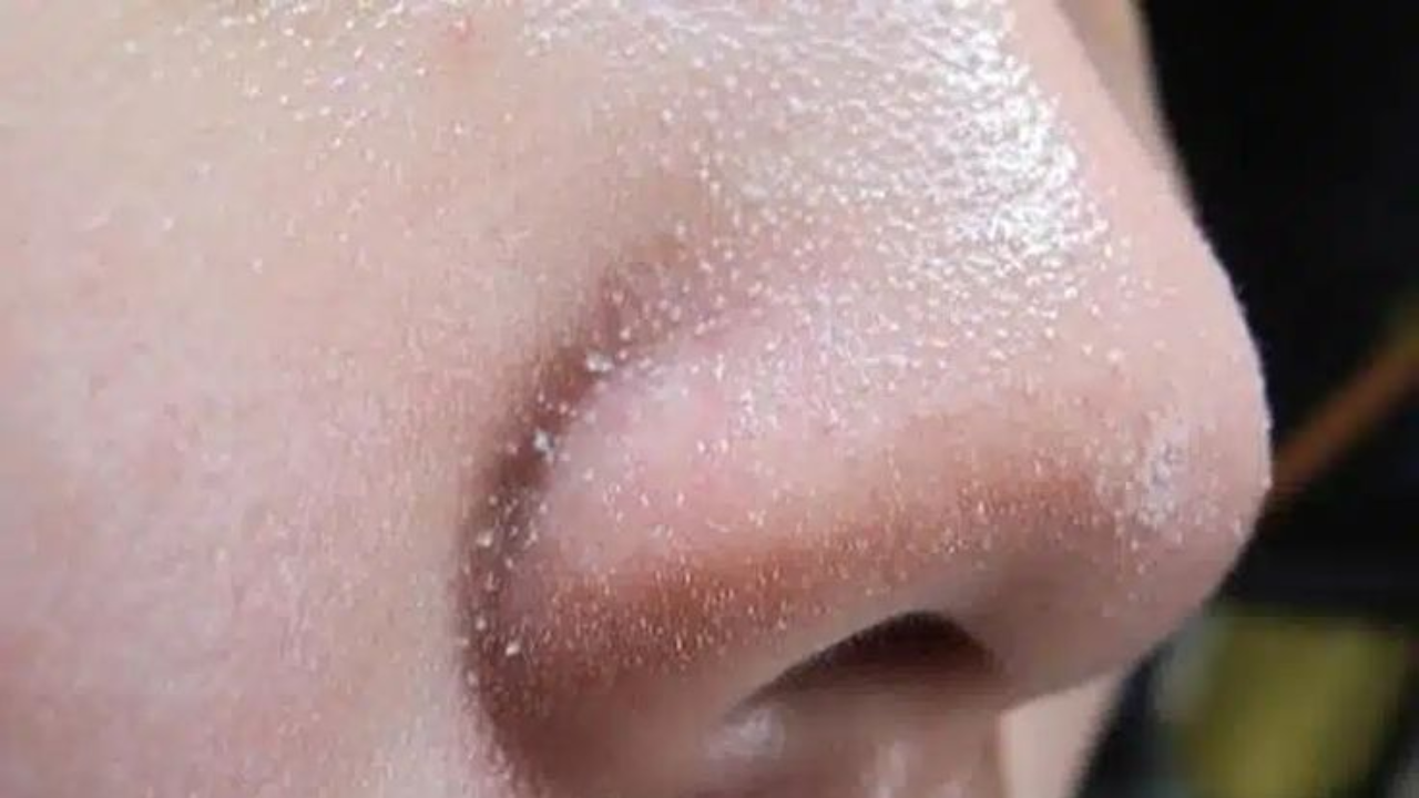 Whiteheads vs Blackheads: Signs, Causes, and More