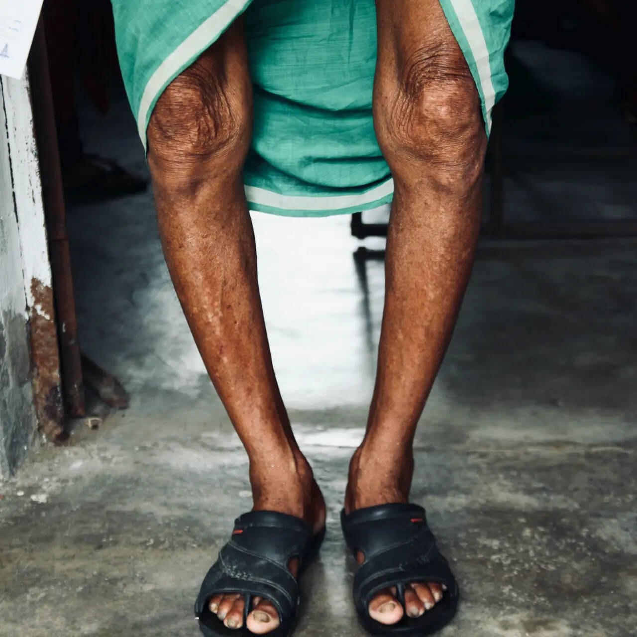 47f97465-8343-4fe8-8224-d6e13413da47_Middle_aged_individual_from_Gharbar_Panchayat_suffering_from_Skeletal_Fluorosis.jpeg