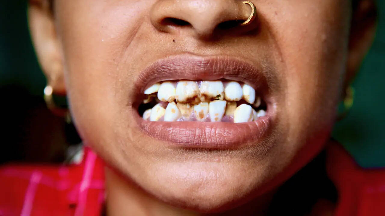 9d76d68a-4340-40d3-af8e-d3a13464ed72_Girl_Child_from_Gharbar_PanchayatSuffering_from_Dental_Fluorosis.jpeg