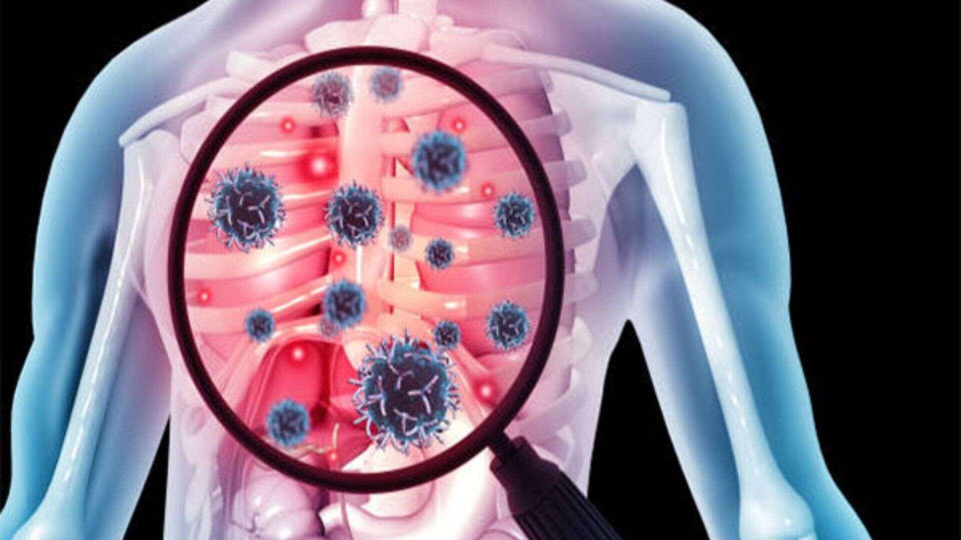 New tool can predict TB death risk at diagnosis, says study