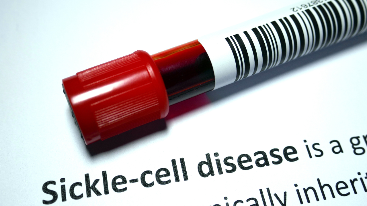 sickle cell disease (2)