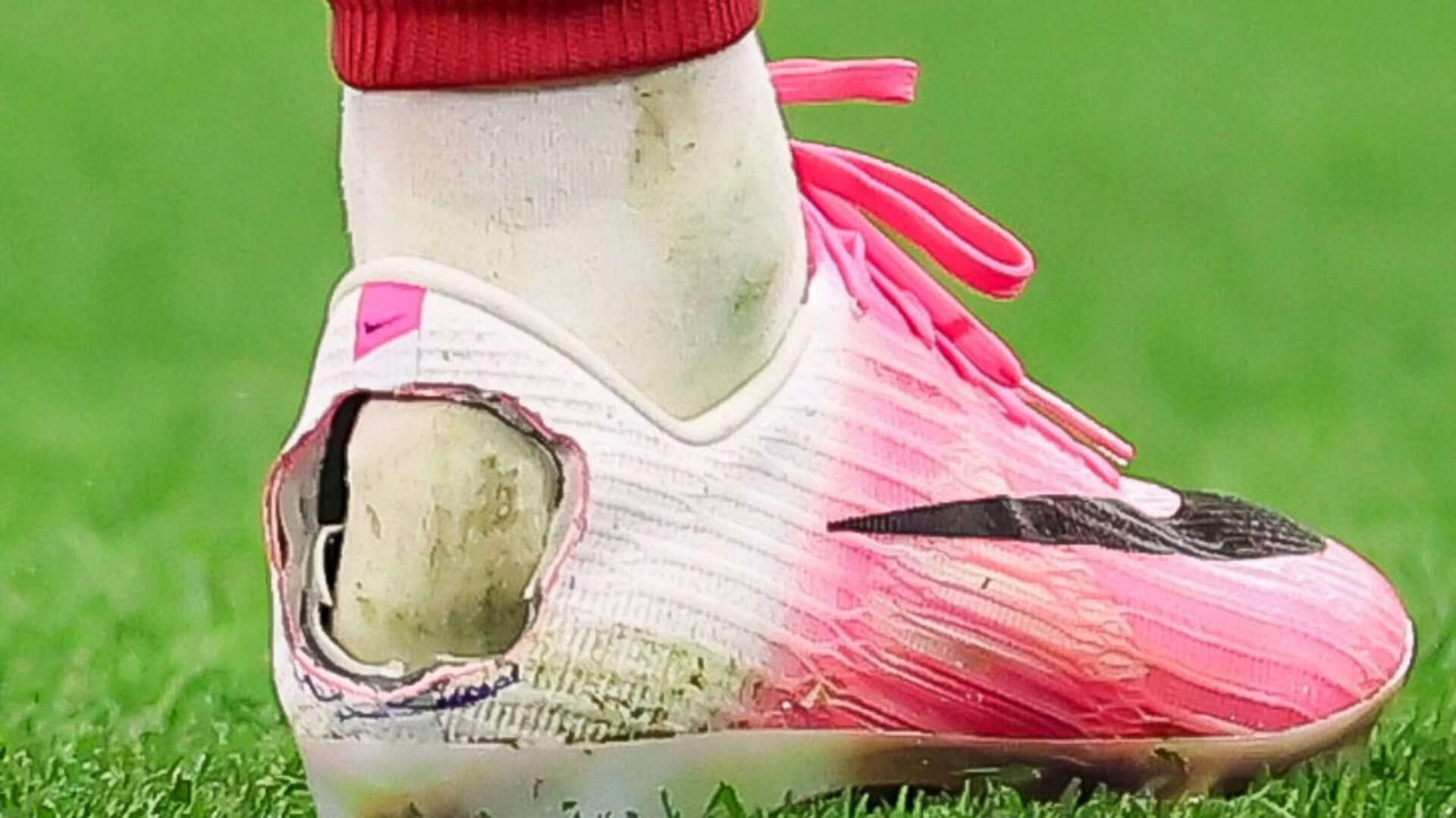 How do soccer players deal with Haglund's Syndrome?