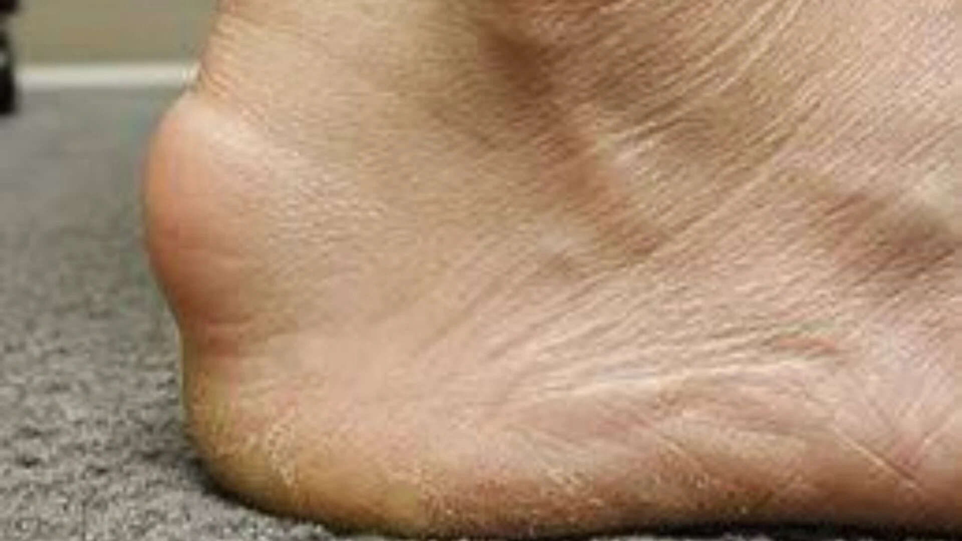 What is Haglund's syndrome?