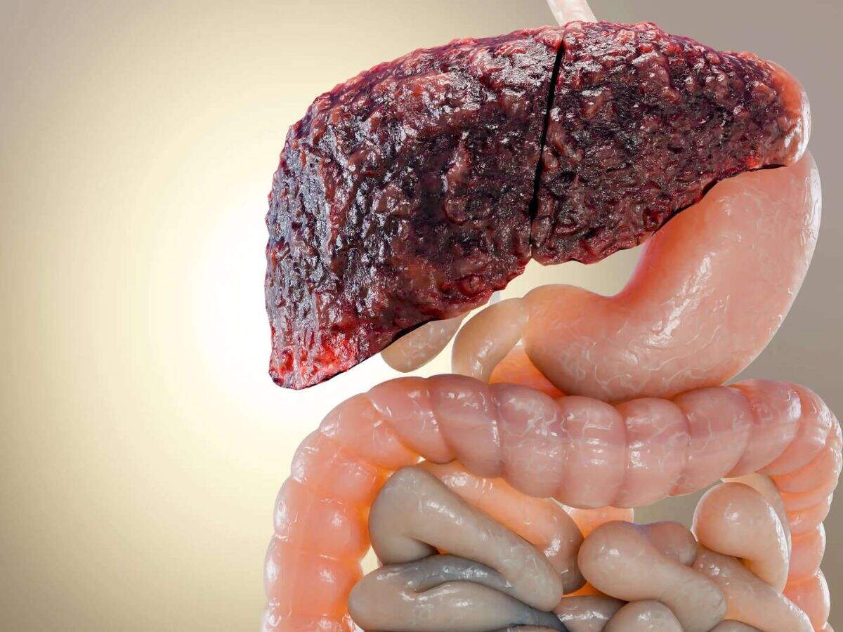 fatty liver treatment