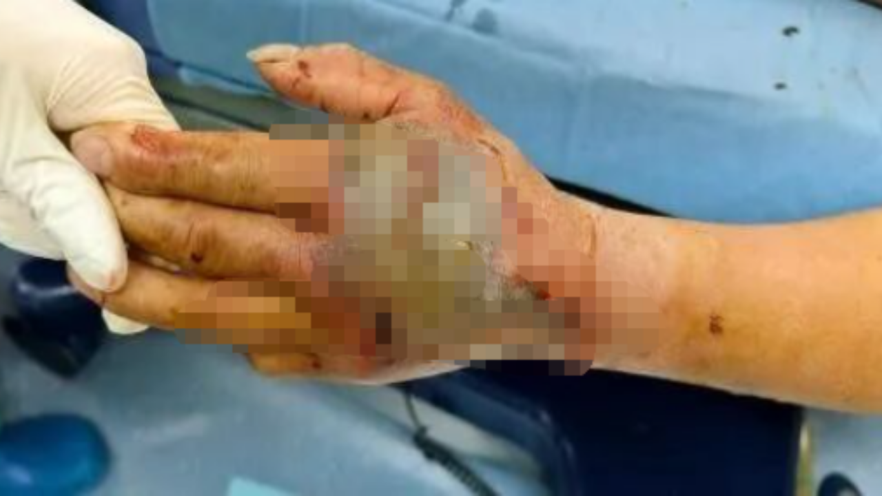 Hand bitten by Cobra