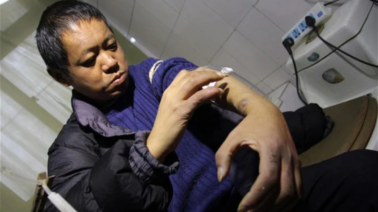 In 2013, a Chinese man who could no longer afford dialysis built his own dialysis machine and survived on it for 13 years<br>