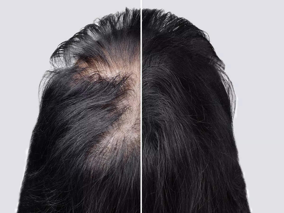 Losing hair because of Alopecia? This Arthritis drug can help you regrow hair like never before