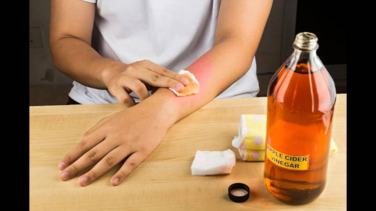 Is it safe to remove moles with apple cider vinegar?