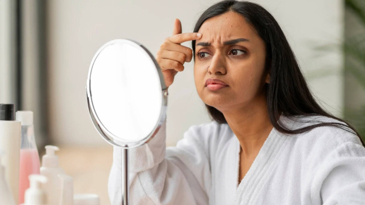 Guide outlines acne types and suggests gentle home remedies and precautions