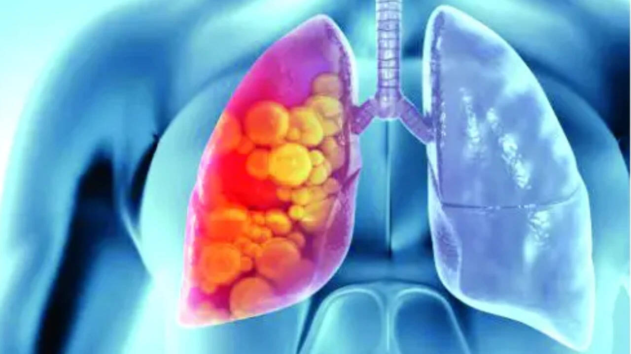 Lung cancer deaths down 16% with low-dose CT screening: IARC