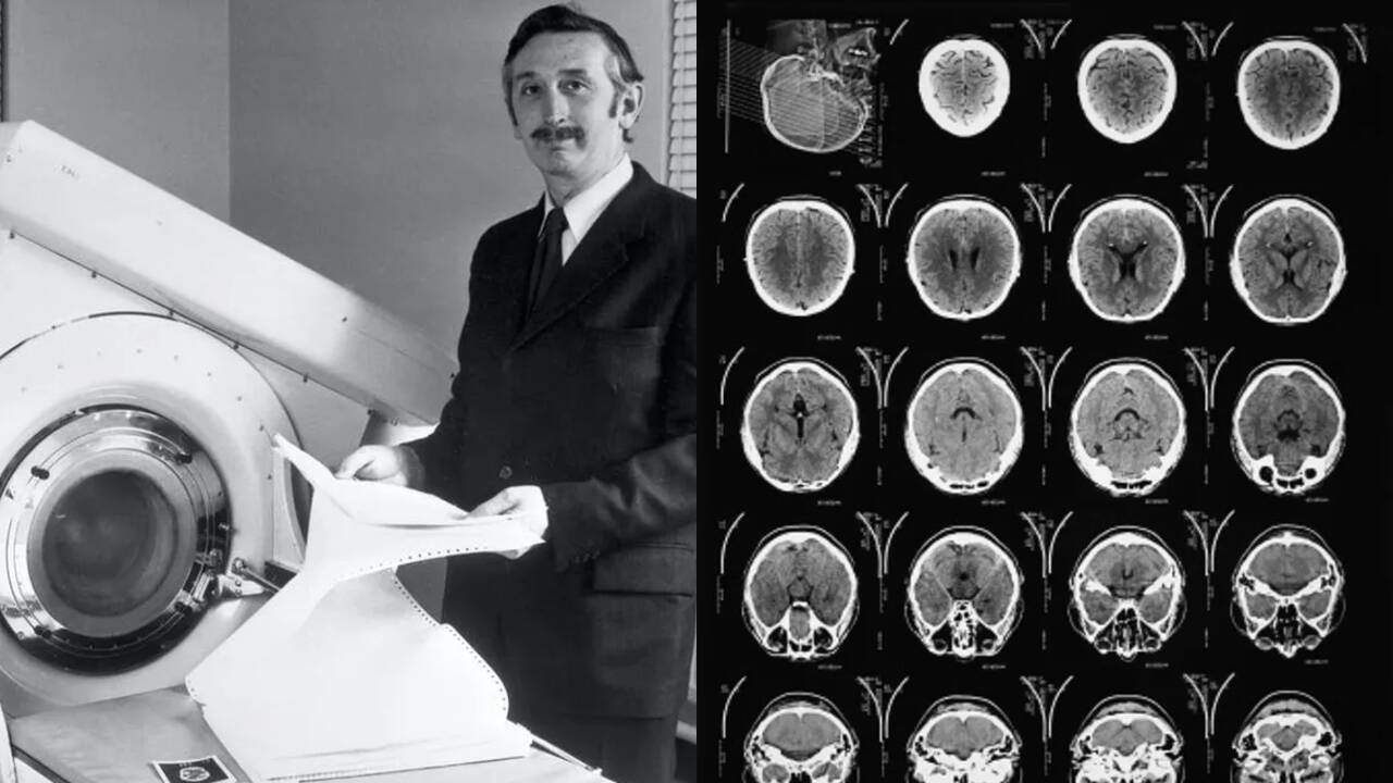 Godfrey Hounsfield’s CT scanner revealed a brain cyst in the first scan in 1971