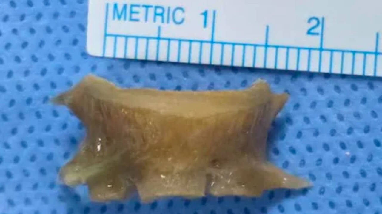 Indian man in UAE had no idea a fish bone was stuck in his airway for over 2 months