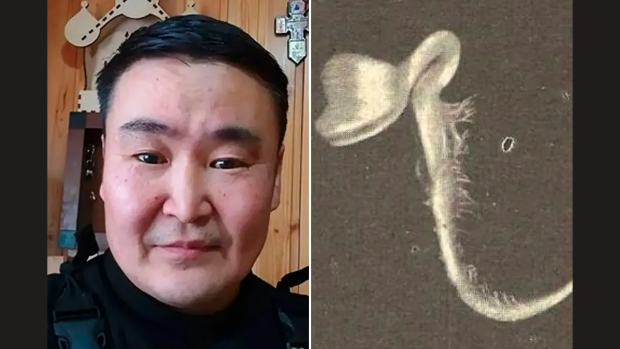 Russian man suffers months of headaches after seed sprouts in his eye
