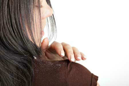 10 Ways To Get Rid Of Dandruff Naturally