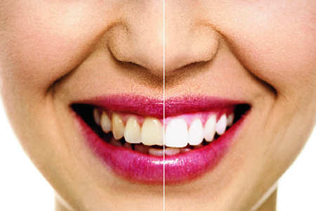 Do teeth whitening pastes, gels help?