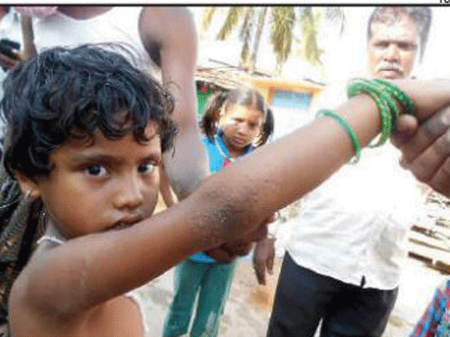 Like this girl, many kids are suffering from skin diseases in the parched Jagalur. (TOI Photo)
