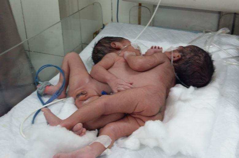 Conjoined twins born in Agra -Photo by Arvind Chauhan