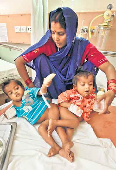 Conjoined twins Sita and Gita separated | Delhi News - Times of India