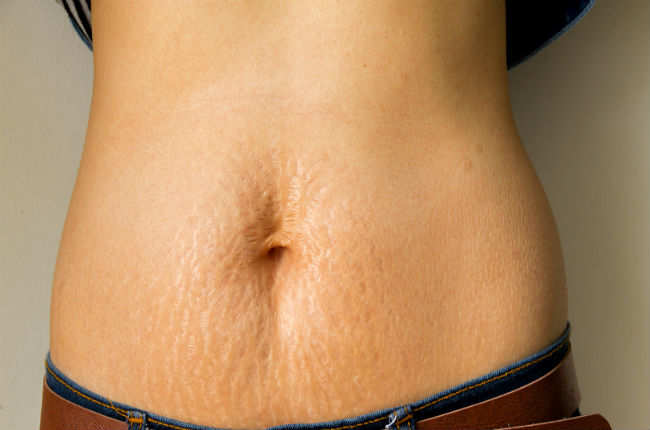The difference and stretch marks - Times India