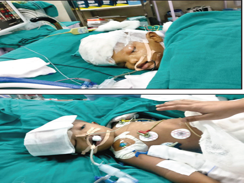 Twins conjoined at head separated after landmark surgery